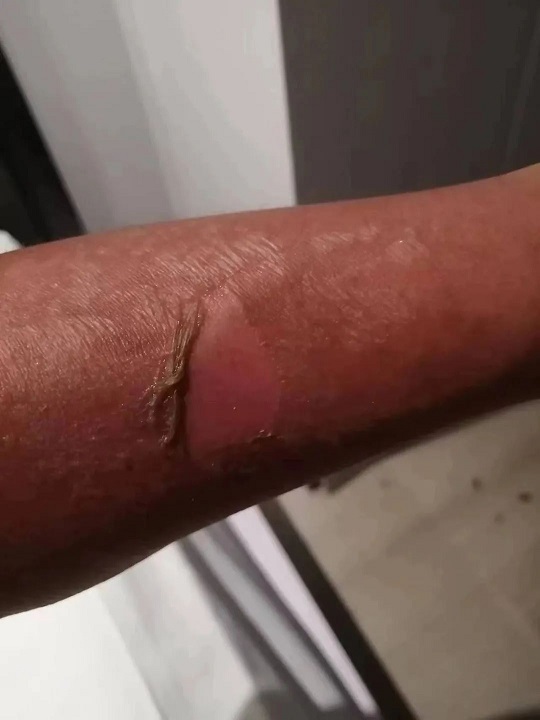 致敬！集团派驻集贤路口防疫工作人员双臂被晒脱皮仍坚持执勤